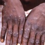 African mpox outbreak Covid