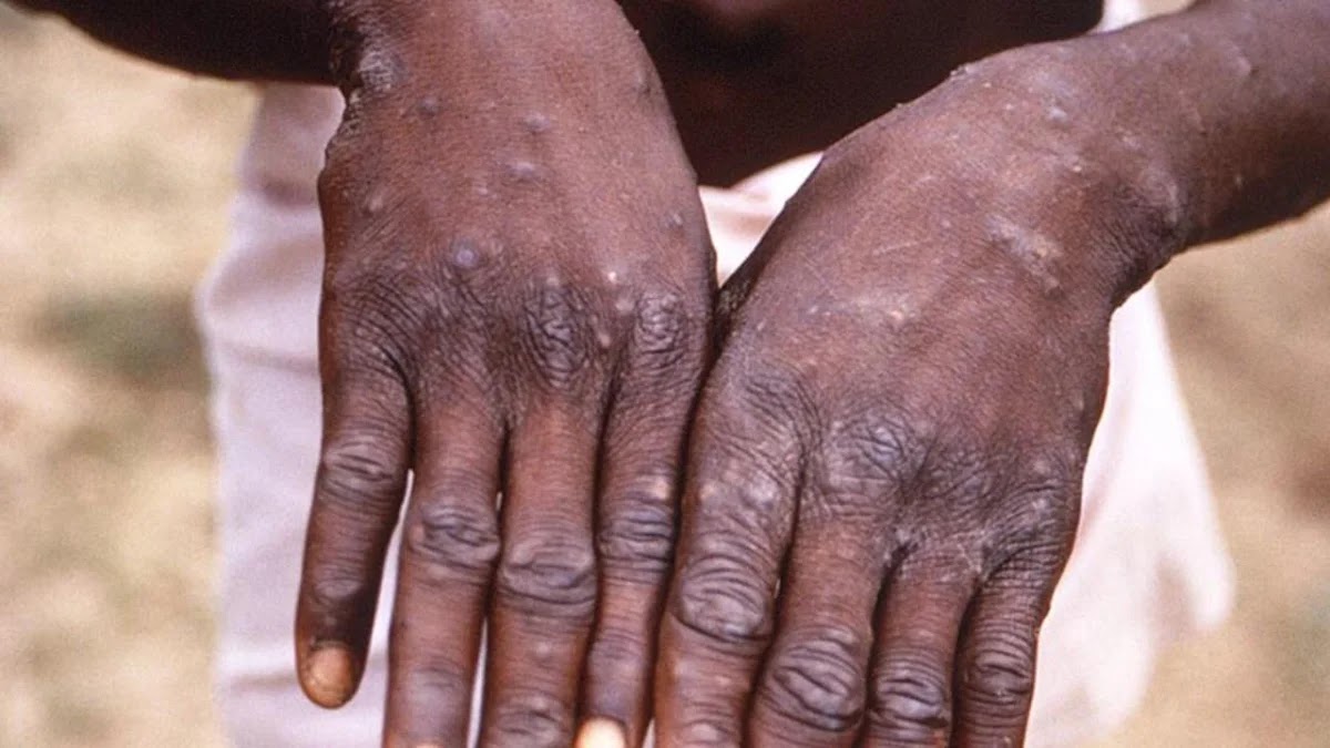 African mpox outbreak Covid